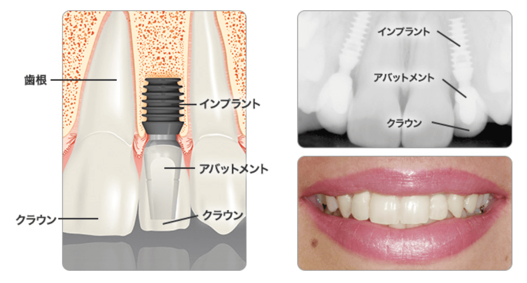 インプラントとは